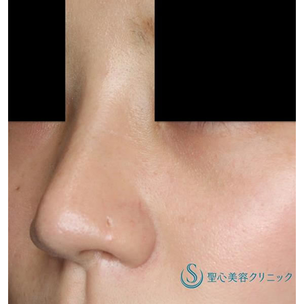鼻の整形 低い鼻 の症例写真 聖心美容クリニック福岡院