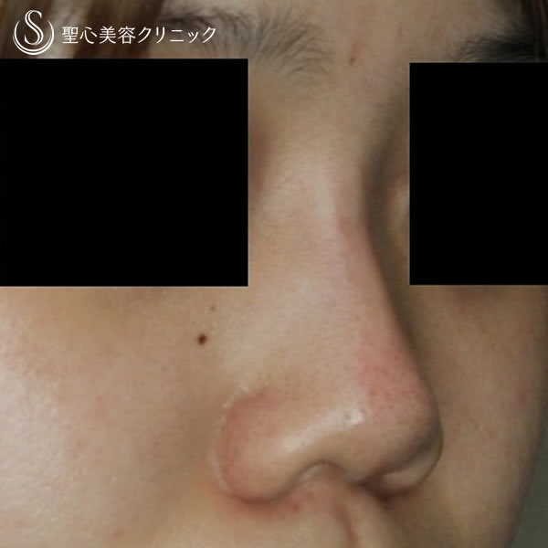 鼻の整形 低い鼻 の症例写真 聖心美容クリニック福岡院